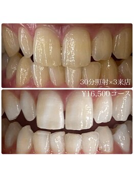 ホワイトニングルーム 横浜店(Whitening Room)/ホワイトニング/横浜