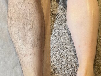 マイカ(myca)/膝下★before&after