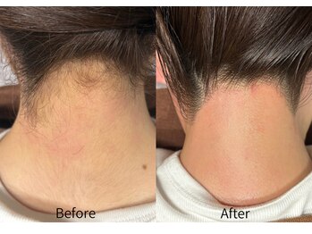 カルーナ 住吉店/うなじMIX脱毛!