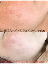 コウベ美容鍼灸治療院(KOBE美容鍼灸治療院)/頬毛穴施術３人気コースハイドロ