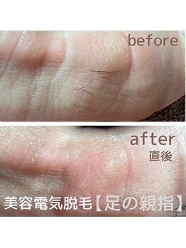 サロン ド ソレイユ(Salon.de.Soleil)/美容電気脱毛☆足指