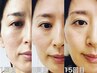 【極たるみ改善&リフトUP】細胞から活性化☆セルラム施術￥30,800→￥29,800