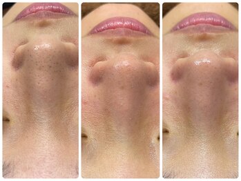 サロン ラズリ 久留米店(SALON Lazuli)/【毛穴洗浄】古い角栓も一掃！