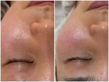 ミュー 金山店(mieux)/くすみが取れてトーンアップ