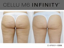 ビューティーリバース センター北店/エンダモロジーインフィニティ