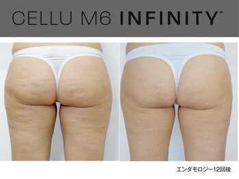 ビューティーリバース センター北店/エンダモロジーインフィニティ