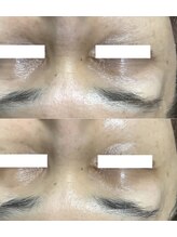 エミルカ 仙台(EMILUCA)/陶肌トリートメント