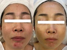 ナポデイズ(NAPODAYS)の雰囲気（毛穴洗浄と肌質改善メニューの組み合わせ。しつこいニキビケアに）