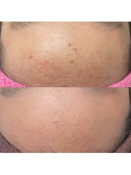 サロンビューティー美優/ニキビ・ハーブピーリング