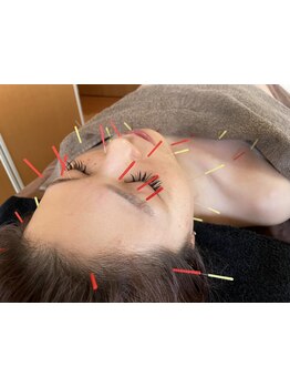 鍼灸施術を受けたい