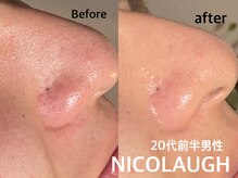 ニコラフ(Nico laugh)/リセットピーリング