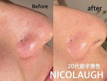 ニコラフ(Nico laugh)/リセットピーリング