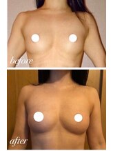 美人バスト 本厚木店/バストアップ◇症例◇