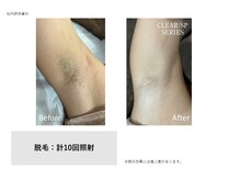 メルシートータルビューティー(MERCI)/ワキの変化