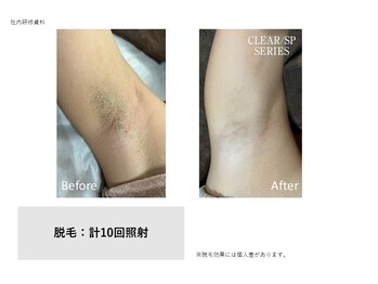 メルシートータルビューティー(MERCI)/ワキの変化