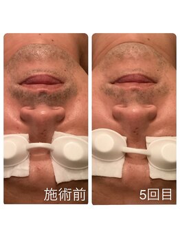 ゲッカ(GEKKA)/ひげ脱毛