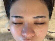 サロン ド エメ(salon de aimer)/【After】赤み鎮静 毛穴縮小
