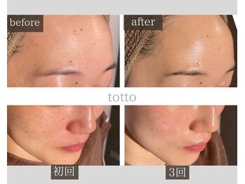 サロントット(salon totto)/before→after　小じわケア
