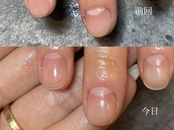 爪が痛まない施術