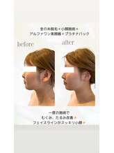 カリス(charis)/小顔