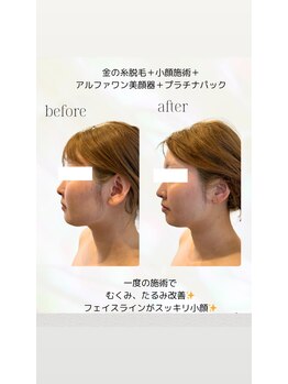 カリス(charis)/小顔