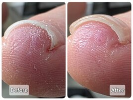 あきらめていた巻き爪