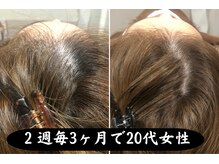 セントラル鍼灸院リラクシー(Re:laxy)/20代でも頭皮を酷使したら
