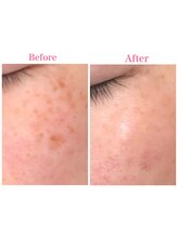 リエット(Lieto)/美肌光の凄さ！！！