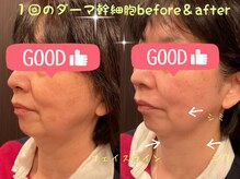 はる鍼灸整骨院/ヒト幹細胞1回でこの効果！