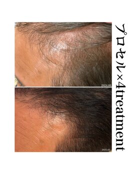 ヒルナム(Heal Nam)/~プロセルセラピーズ~頭皮