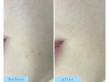 アフロディーテ(APHRODITE)/ビフォーアフター