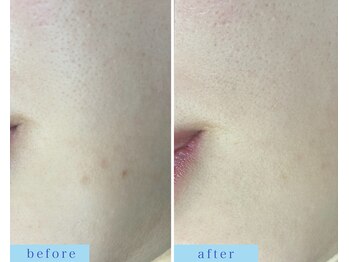 アフロディーテ(APHRODITE)/ビフォーアフター