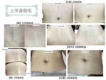 ベルスタイル(Bell style)/当店のお客様症例(上半身脱毛)