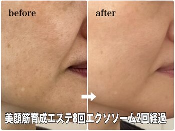 リエル(RIEL)/小顔矯正×美顔筋育成エステ