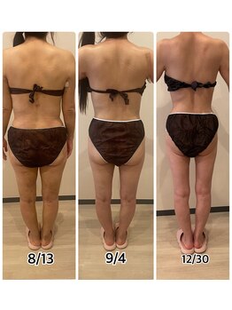 インディバジェム(GEM)/ビフォーアフター