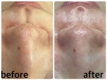 エクラニーク(Eclanique)/小鼻もシュガーリング脱毛で