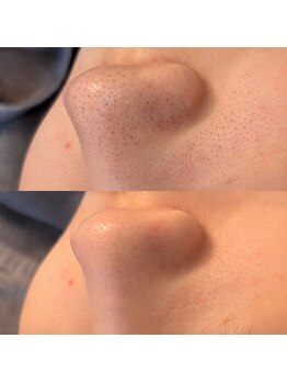 ワンブルーム(OneBloom)の写真/夏の皮脂による毛穴つまりをケアし黒ずみを一掃しうる艶肌へ導く!毛穴と小顔が叶う贅沢なコースも人気☆