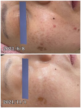 プチ プロムナード(Petit Promenade)/乳酸ピーリング♪