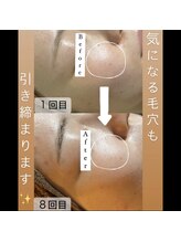 カヨン 新所沢店(KAYON)/ハーブピーリング Before→After