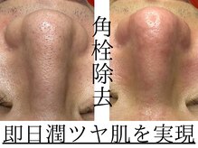 サロン イナンナ(Salon INANNA)/尾張旭ハーブピーリング/瀬戸