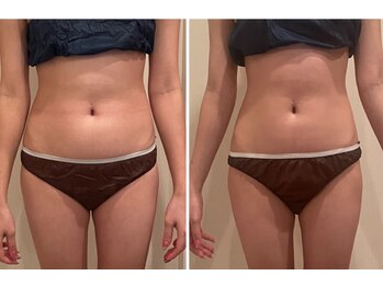 モモン シャルール/ハイパーナイフ初回施術前&後