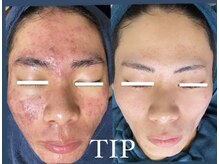 ムーンリズム(Moonlism)/【TIPハーブ症例】肌荒れ