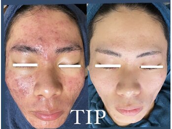 ムーンリズム(Moonlism)/【TIPハーブ症例】肌荒れ