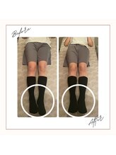 アクア(AQUA)/O脚矯正