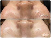 サロン ラズリ 久留米店(SALON Lazuli)/【幹細胞毛穴ケア】イオンの力！