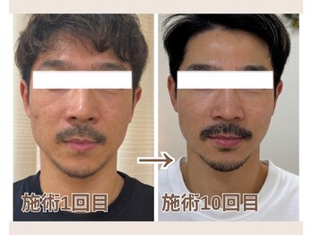 ルビーミー(Ruby's Me)/美顔筋テラボーラー症例