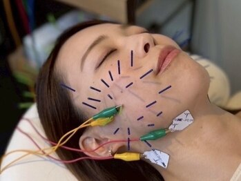 チョコバリ 渋谷店(chocobari)の写真/【小顔リフト美容鍼◆初回2980円】国家資格の高技術スタッフが対応♪初めての方や速効効果を実感したい方に