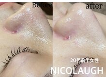 ニコラフ(Nico laugh)/リセットピーリング