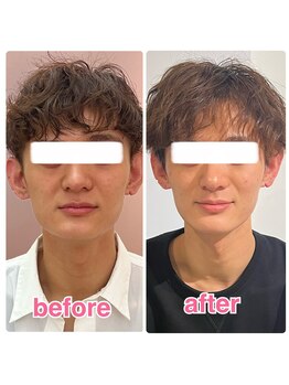 ヴィヴィアナ(viviana)/頬骨とエラを何とかしたい！