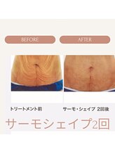 ユウキ(yuuki)/サーモシェイプDeep2回